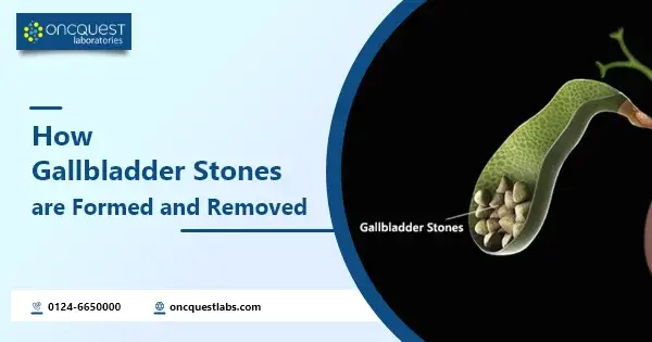 how gallbladder stones are formed and removed