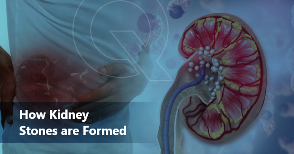 how kidney stones are formed